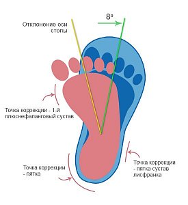 Варусная деформация стопы